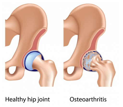 Hip Arthritis