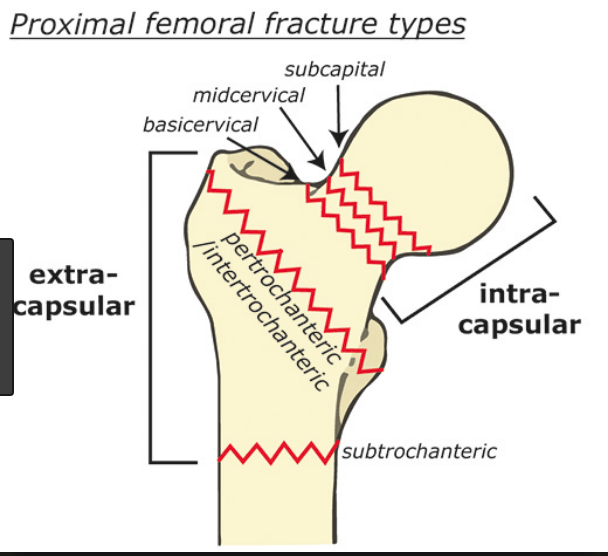 Proximal Femoral Fractures